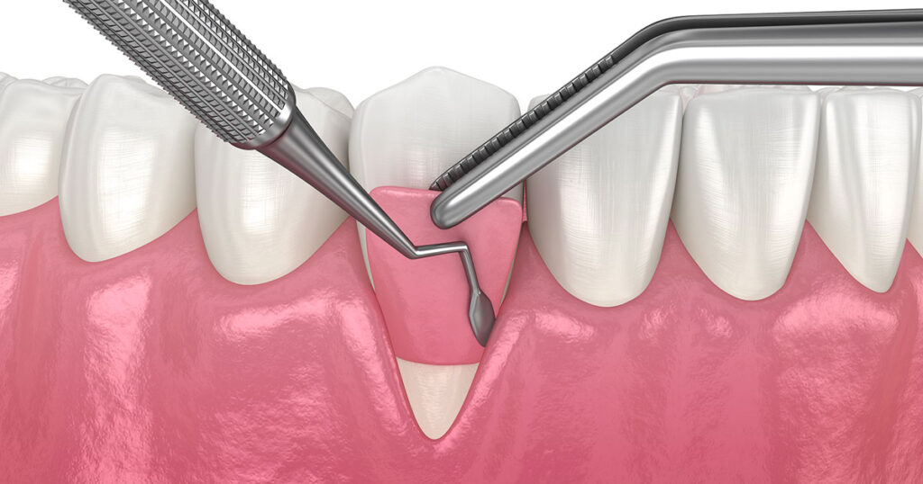 Greffe gingivale Paris